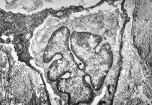 M, 70y. | mycosis fungoides - Sézary cell